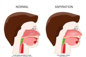 Regaining Swallowing After Stroke