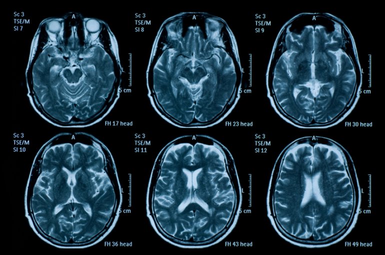 Balancing the Risks and Benefits of Using Adderall for TBI