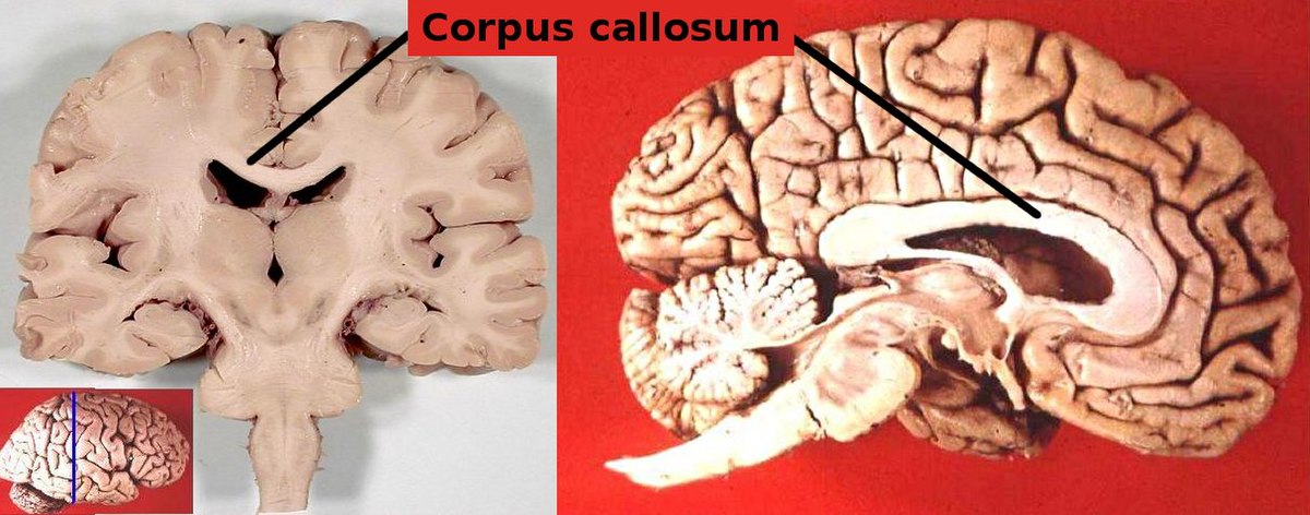 Corpus Callosum Stroke