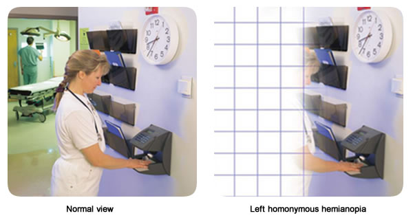 Left Visual Field Impairment