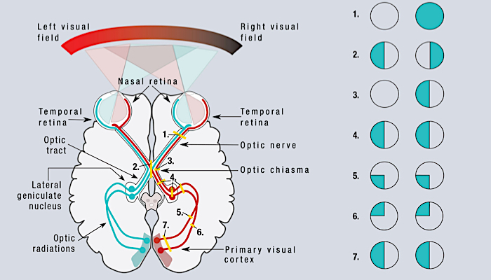 Left Visual Field Impairment