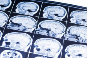 Healing Brain Damage Naturally: No Prescription Required