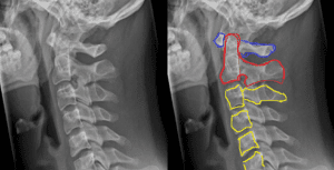 C1 Spinal Cord Injury