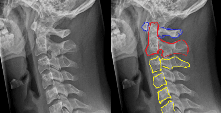 C1 Spinal Cord Injury