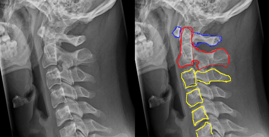 C1 Spinal Cord Injury