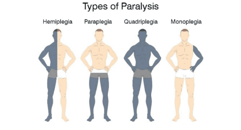 Quadriplegia and Its Recovery