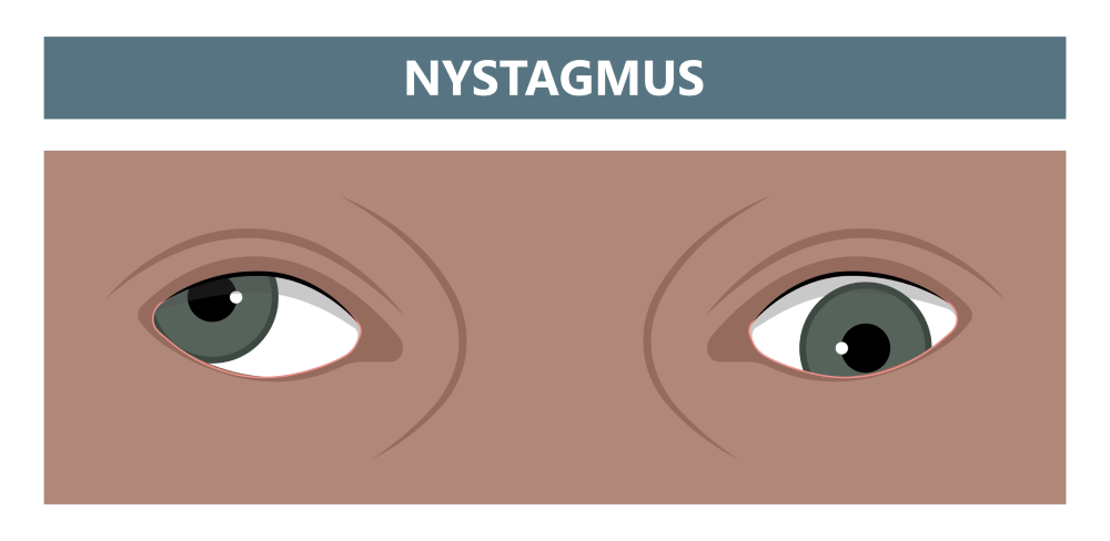 How to Treat Nystagmus After Head Injury