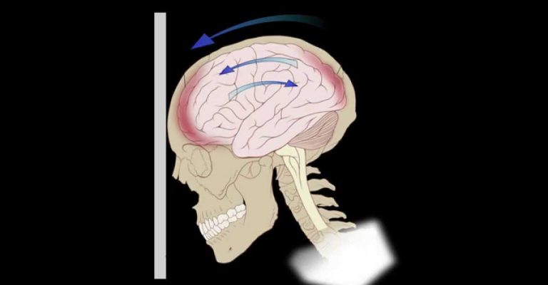 Coup Contrecoup Injury Causes Symptoms And Treatment