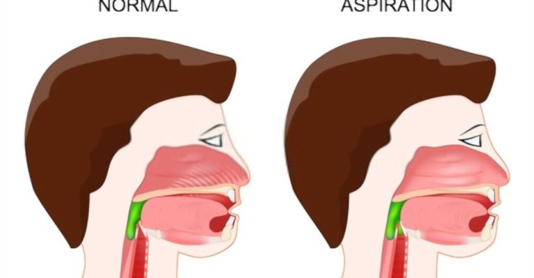 Regaining Swallowing After Stroke