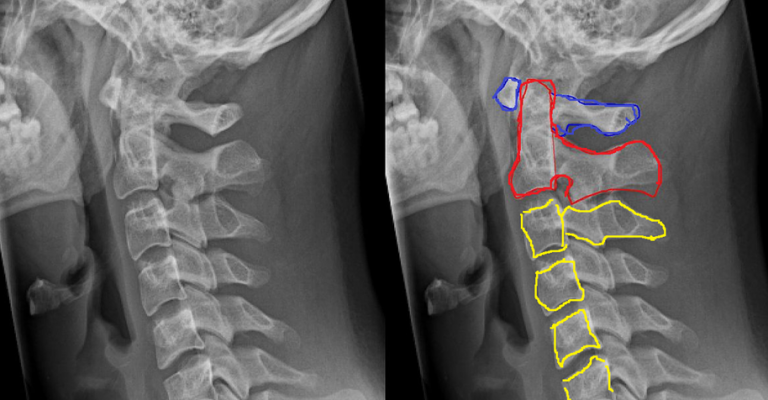 C1 Spinal Cord Injury